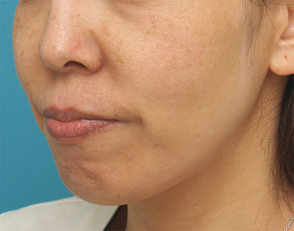 症例写真,顎の梅干しジワに注射式シワ取り ボツリヌストキシン注射した症例写真,Before,ba_botox_pic15_b.jpg