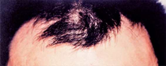 医療植毛 前頭部の生え際、両サイドの後退がお悩みの患者様の症例,Before,ba_hair09_b.jpg