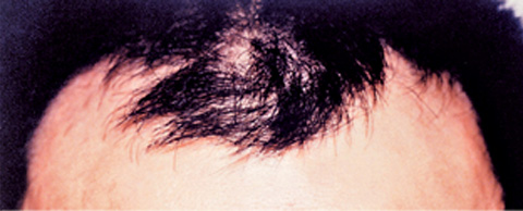 症例写真,医療植毛 前頭部の生え際、両サイドの後退がお悩みの患者様の症例,植毛前,mainpic_hair_transplant01a.jpg