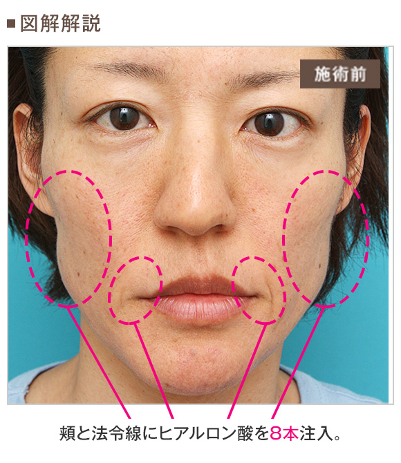 ヒアルロン酸注射は数ヶ月 数年で吸収されるといわれてますが 半永久に残る場合もあります Dr 高須幹弥の美容整形講座 美容整形の高須クリニック