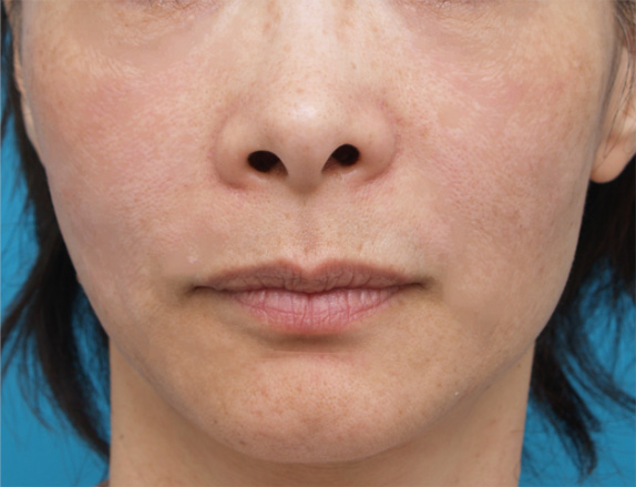 症例写真,注射式シワ取りの症例 長期持続型ヒアルロン酸注入 痩せたために頬がこけていた女性,After,ba_hyaluronic_pic23_b.jpg