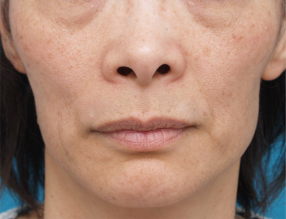 症例写真,注射式シワ取りの症例 長期持続型ヒアルロン酸注入 痩せたために頬がこけていた女性,Before,ba_hyaluronic_pic23_b.jpg
