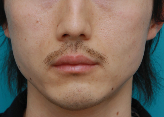 頬が痩けた男性にヒアルロン酸を10cc注射して膨らませた症例写真,After,ba_hyaluronic24_a01.jpg