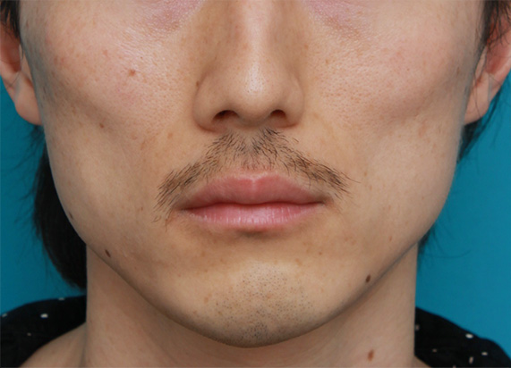 頬をふっくら・ヒアルロン酸注射,注射式シワ取り 長期持続型ヒアルロン酸注入,頬が痩けた男性にヒアルロン酸を10cc注射して膨らませた症例写真,Before,ba_hyaluronic24_b.jpg