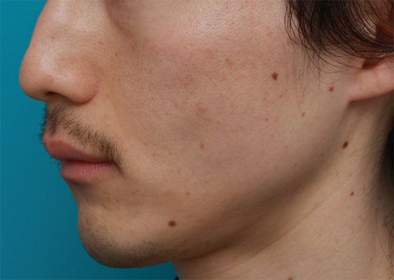 症例写真,頬が痩けた男性にヒアルロン酸を10cc注射して膨らませた症例写真,After,ba_hyaluronic25_b.jpg