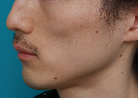 症例写真,頬が痩けた男性にヒアルロン酸を10cc注射して膨らませた症例写真,Before,ba_hyaluronic25_b.jpg