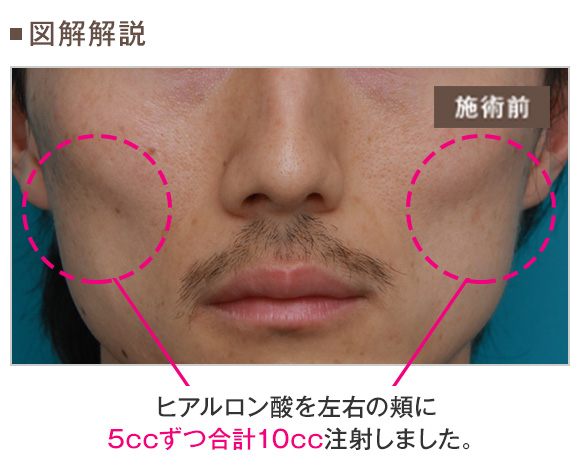 頬が痩けた男性にヒアルロン酸を10cc注射して膨らませた症例写真 美容整形の高須クリニック 東京赤坂 横浜 名古屋 大阪