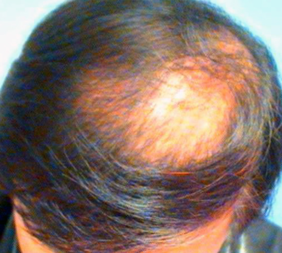 症例写真,AGA治療（高須式メディカル育毛プログラム）　HARG療法を施術,Before,ba_aga_18_b.jpg