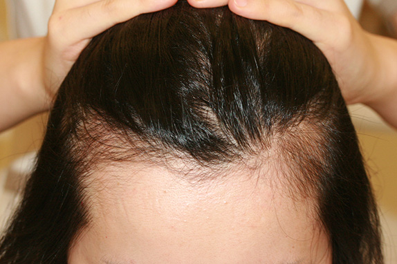症例写真,女性の薄毛治療（HARG療法）の症例写真,Before,ba_aga_13_b.jpg