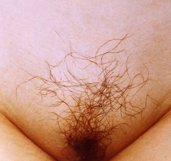 性毛（陰毛）植毛の症例 生まれつきの薄すぎる体毛にお悩みの女性,Before,ba_pubic_hair02_b.jpg