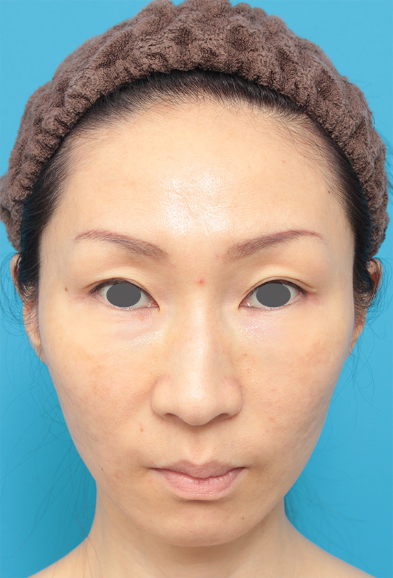 症例写真,頬がこけて窪んでいる部分にヒアルロン酸を注射し、張りのある顔になった症例写真の画像,After,ba_hyaluronic27_b.jpg