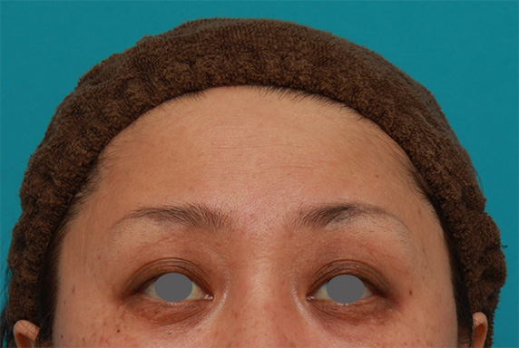 症例写真,額のシワにヒアルロン酸注射した症例写真の術前術後画像,After（1週間後）,ba_hyaluronic41_b.jpg