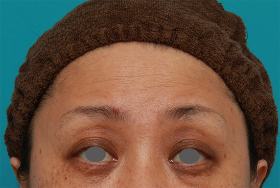 症例写真,額のシワにヒアルロン酸注射した症例写真の術前術後画像,Before,ba_hyaluronic41_b.jpg