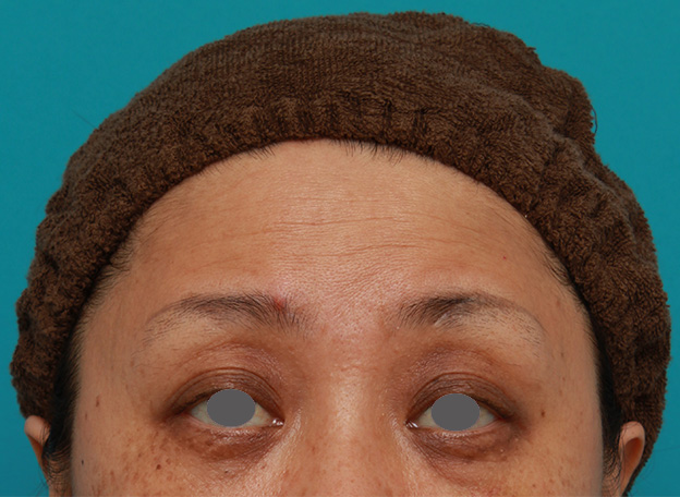 症例写真,額のシワにヒアルロン酸注射した症例写真の術前術後画像,注射前,mainpic_hyaluronic03a.jpg