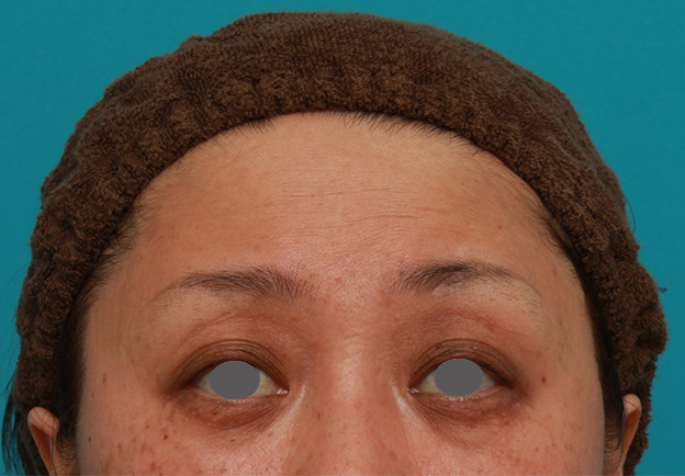 症例写真,額のシワにヒアルロン酸注射した症例写真の術前術後画像,注射直後,mainpic_hyaluronic03b.jpg
