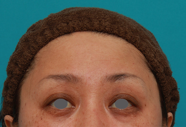 症例写真,額のシワにヒアルロン酸注射した症例写真の術前術後画像,1週間後,mainpic_hyaluronic03c.jpg