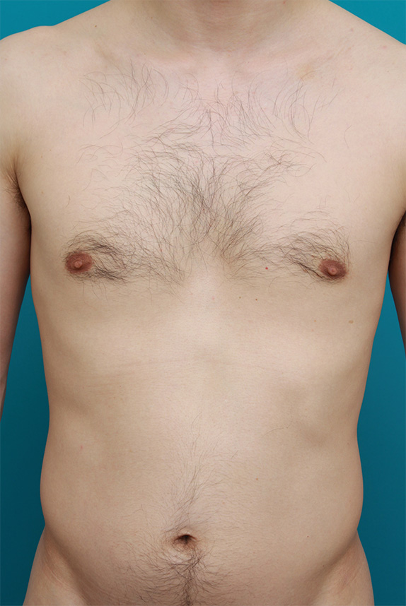 30代男性の胸毛、乳毛、腹毛、ヘソまわりの毛をレーザー脱毛で永久脱毛した症例写真,Before,ba_epi09_b.jpg