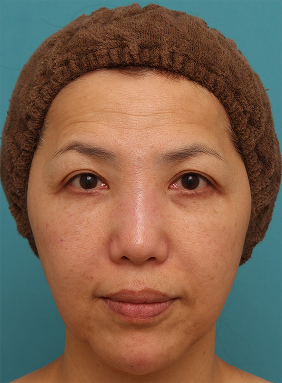 ゴルゴ線、法令線、マリオネットライン、顎のシワにヒアルロン酸注射をした症例写真の術前術後画像,After,ba_hyaluronic42_a01.jpg