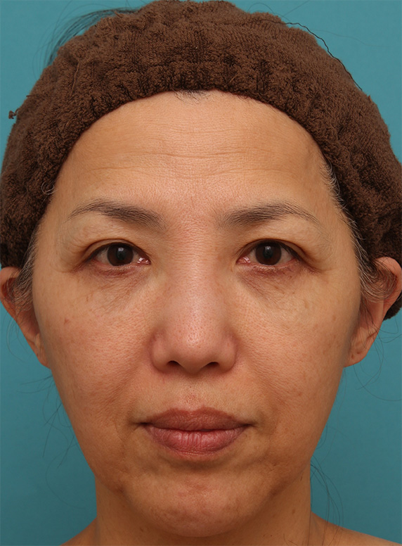 ゴルゴ線、法令線、マリオネットライン、顎のシワにヒアルロン酸注射をした症例写真の術前術後画像,Before,ba_hyaluronic42_b.jpg