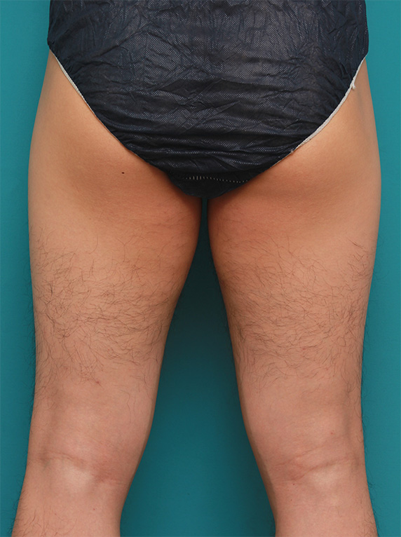 症例写真,男性の太もも、ビキニラインの無駄毛をレーザー永久脱毛（医療脱毛）した症例写真,Before,ba_epi11_b.jpg