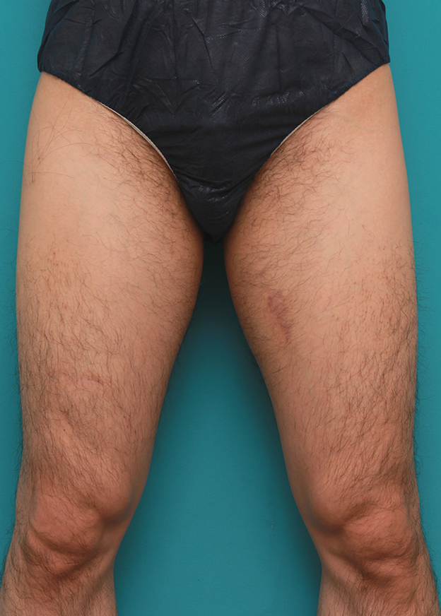 症例写真,男性の太もも、ビキニラインの無駄毛をレーザー永久脱毛（医療脱毛）した症例写真,治療前,mainpic_epi02a.jpg