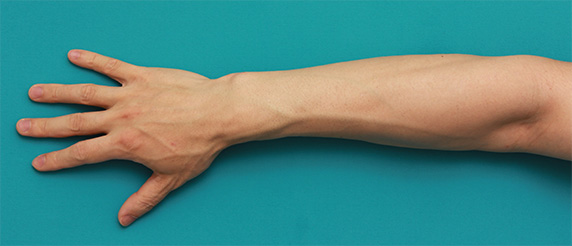 症例写真,男性の手の甲、手の指、前腕のムダ毛をレーザー医療脱毛で永久脱毛した症例写真,After（8回治療後2ヶ月）,ba_epi12_b.jpg