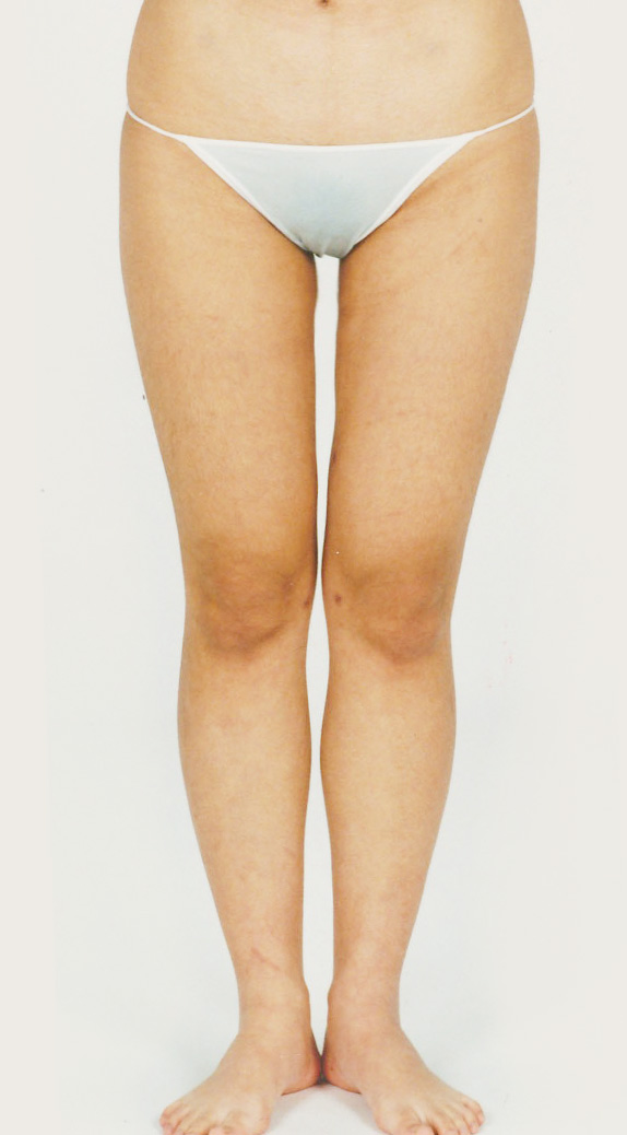 脂肪吸引の症例写真　大腿,After,ba_shibokyuin31_a01.jpg