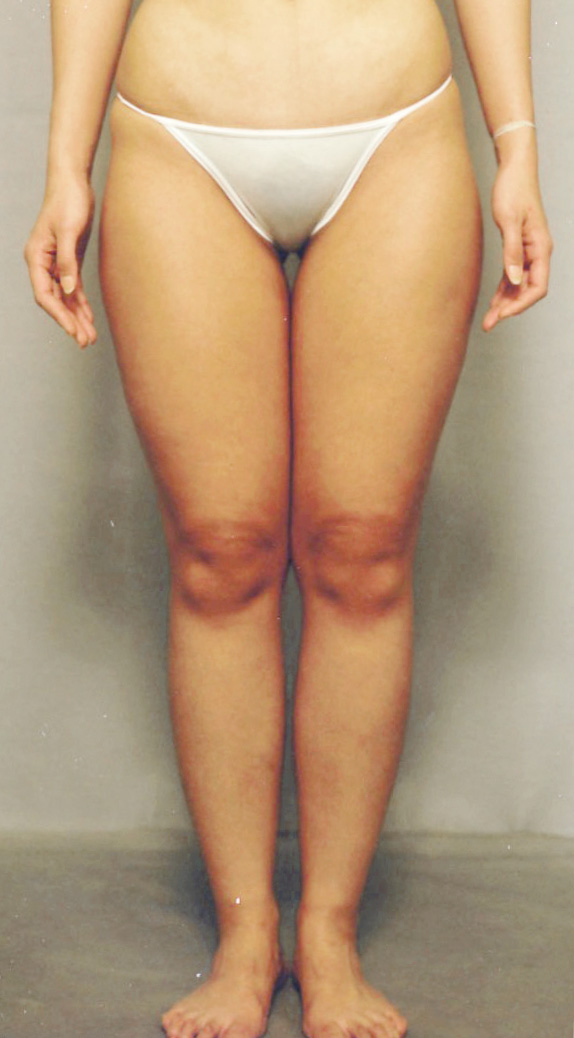 脂肪吸引の症例写真　大腿,Before,ba_shibokyuin31_b.jpg