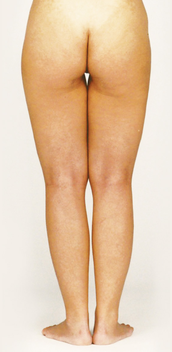 症例写真,脂肪吸引の症例写真　大腿,Before,ba_shibokyuin33_b.jpg