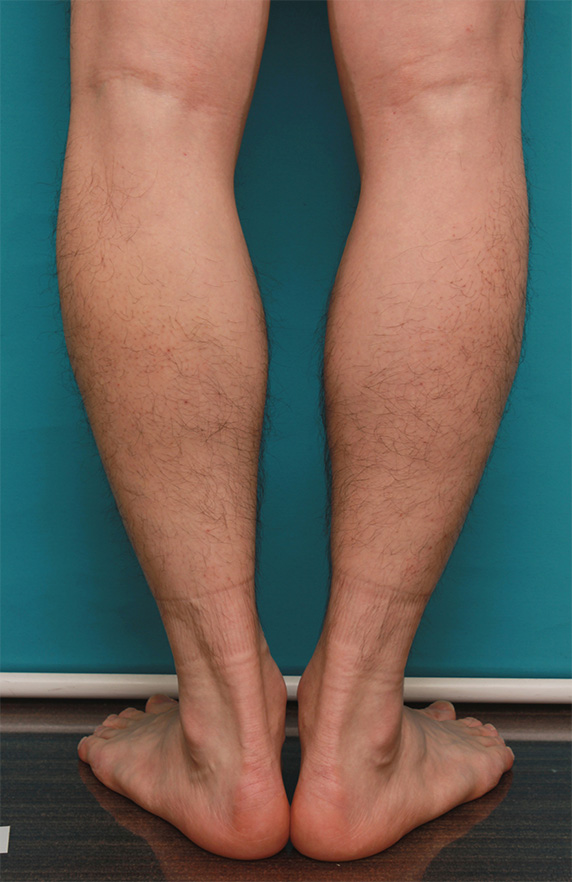 症例写真,男性の濃いすね毛をレーザー医療脱毛で永久脱毛した症例写真,Before,ba_epi15_b.jpg