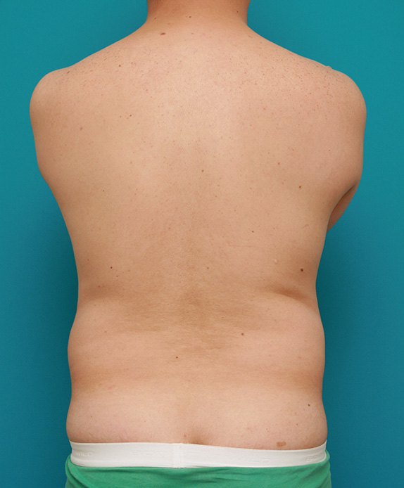 症例写真,脂肪吸引の症例 お腹がでっぱり背中も脂肪が段になっていた40代男性,Before,ba_shibokyuin43_b.jpg