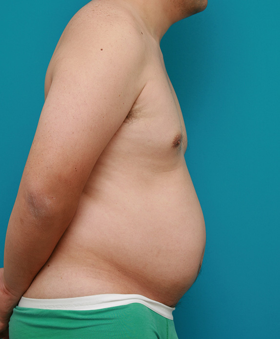 症例写真,脂肪吸引の症例 お腹がでっぱり背中も脂肪が段になっていた40代男性,Before,ba_shibokyuin45_b.jpg