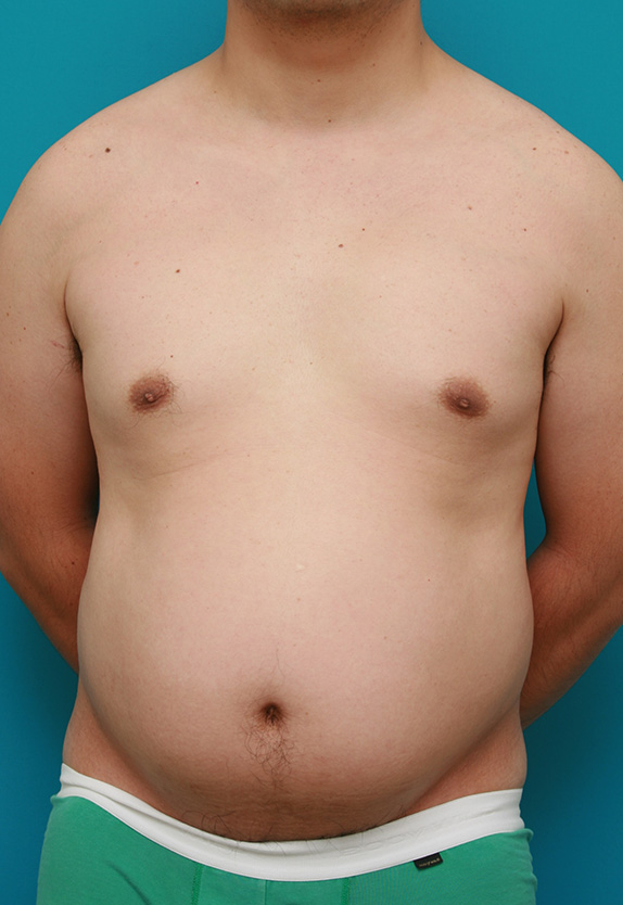 症例写真,脂肪吸引の症例 お腹がでっぱり背中も脂肪が段になっていた40代男性,Before,ba_shibokyuin52_b.jpg