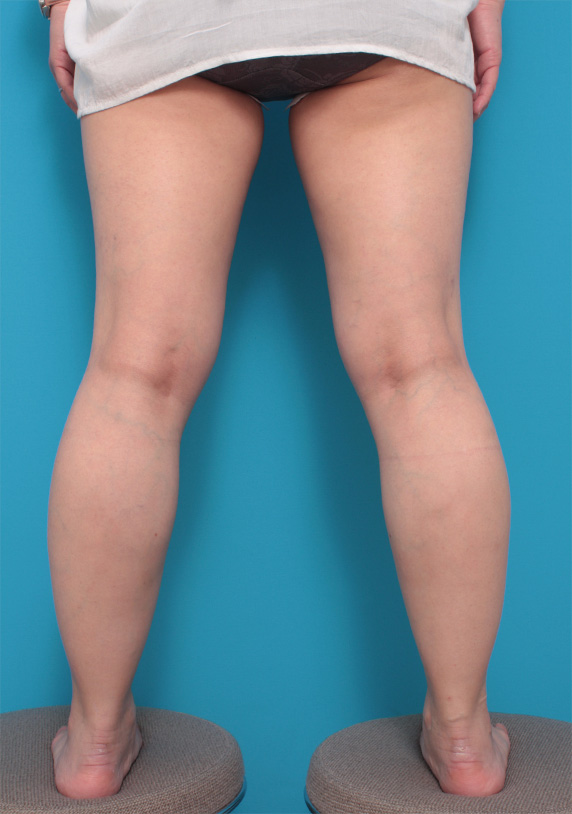ボツリヌストキシン注射（ふくらはぎ・足やせ・美脚）症例写真 ふくらはぎ痩身希望の30代女性,After,ba_leg_04_a01.jpg