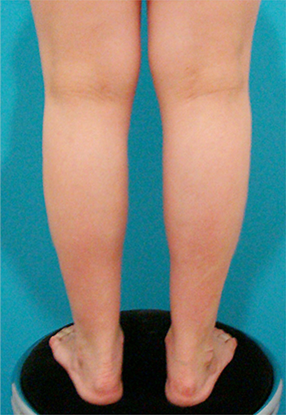 ボツリヌストキシン注射（ふくらはぎ・足やせ・美脚）症例写真 筋肉太りタイプ,After,ba_leg_01_a01.jpg