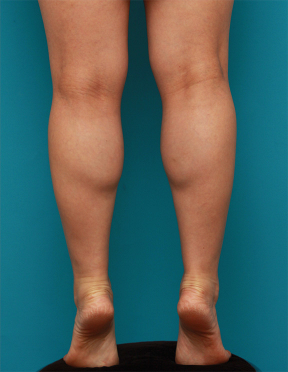 ボツリヌストキシン注射（ふくらはぎ・足やせ・美脚）症例写真,Before,ba_leg_02_b.jpg