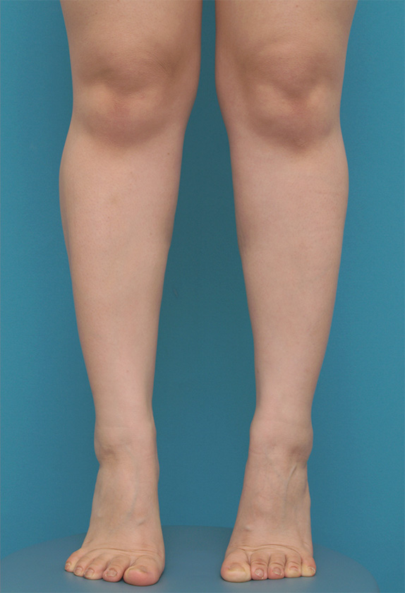 症例写真,ボツリヌストキシン注射（ふくらはぎ・足やせ・美脚）の正面・側面・後面症例写真,After（2ヶ月後）,ba_leg_03a_b.jpg