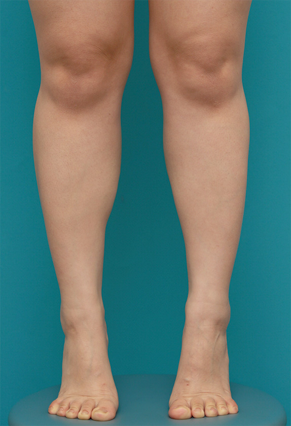 ボツリヌストキシン注射（ふくらはぎ・足やせ・美脚）の正面・側面・後面症例写真,Before,ba_leg_03a_b.jpg
