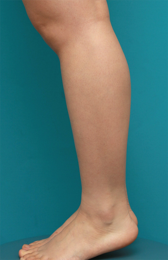 症例写真,ボツリヌストキシン注射（ふくらはぎ・足やせ・美脚）の正面・側面・後面症例写真,Before,ba_leg_03b_b.jpg