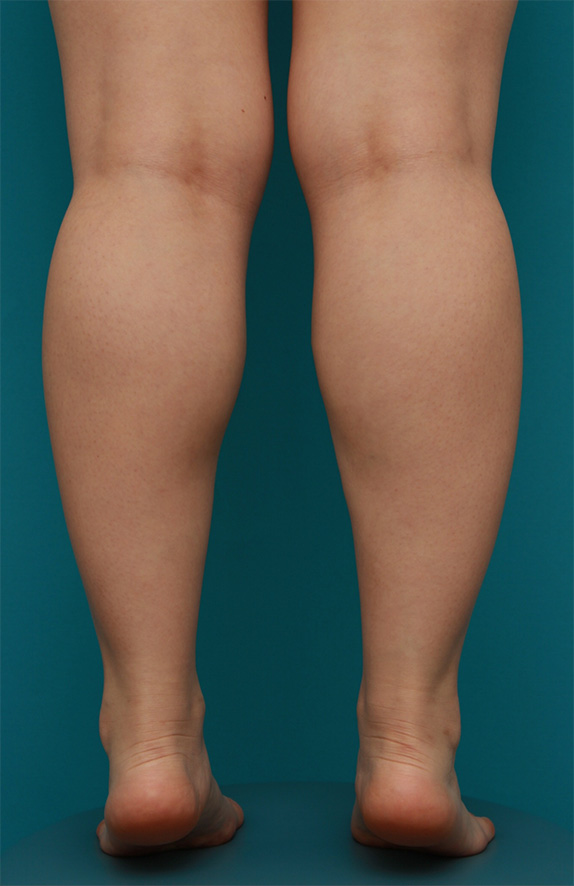 症例写真,ボツリヌストキシン注射（ふくらはぎ・足やせ・美脚）の正面・側面・後面症例写真,Before,ba_leg_03c_b.jpg