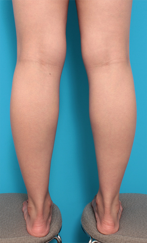ボツリヌストキシン注射（ふくらはぎ・足やせ・美脚）,ボツリヌストキシン注射（ふくらはぎ・足やせ・美脚）でふくらはぎの筋肉を痩せさせて細くした症例写真の術前術後画像の解説,Before,ba_leg08_b.jpg