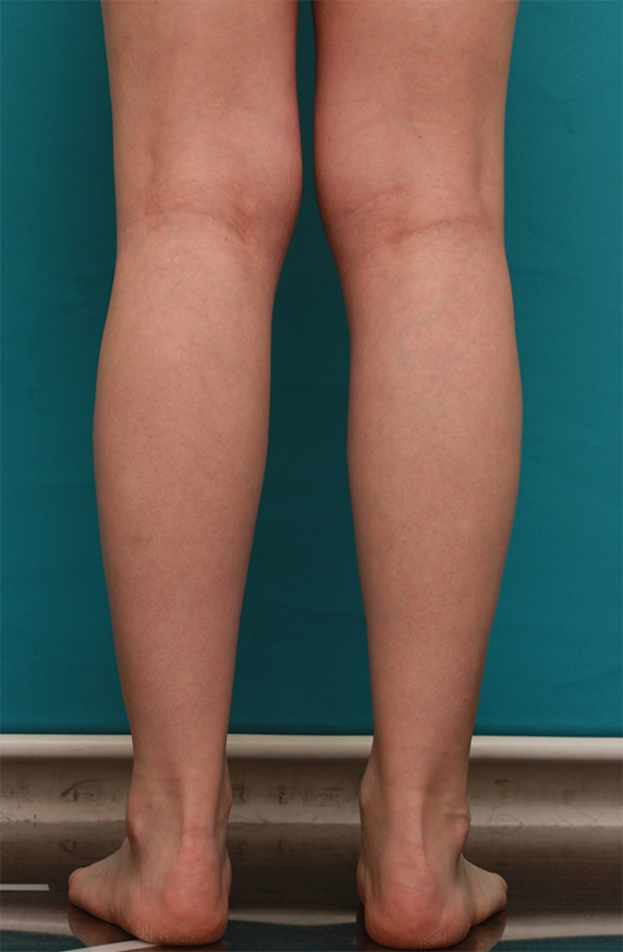 ボツリヌストキシン注射（ふくらはぎ・足やせ・美脚）で腓腹筋とヒラメ筋を萎縮させ、細い美脚にした症例写真の術前術後画像,After（3ヶ月後）,ba_leg13_a01.jpg