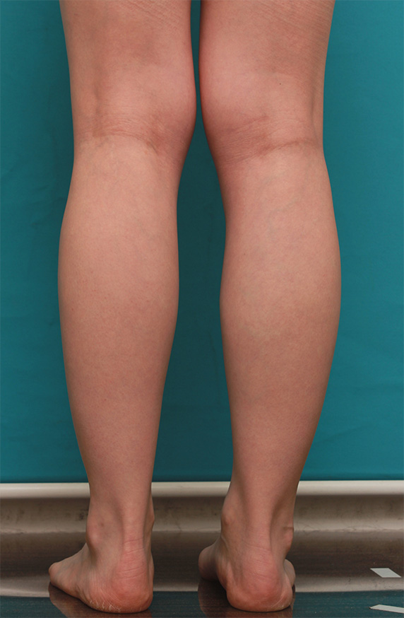 ボツリヌストキシン注射（ふくらはぎ・足やせ・美脚）で腓腹筋とヒラメ筋を萎縮させ、細い美脚にした症例写真の術前術後画像,Before,ba_leg13_b.jpg