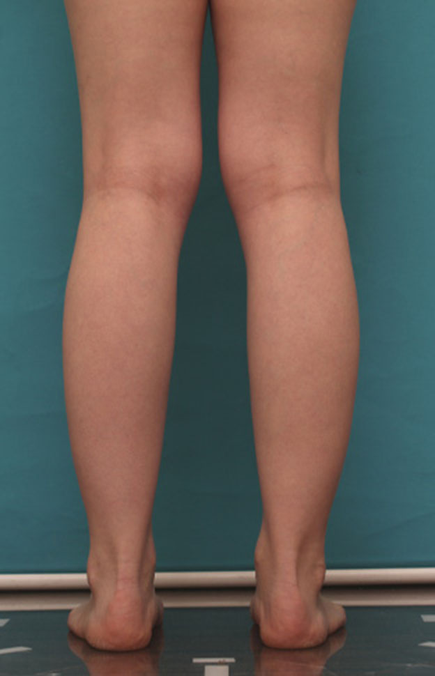 症例写真,ボツリヌストキシン注射（ふくらはぎ・足やせ・美脚）で腓腹筋とヒラメ筋を萎縮させ、細い美脚にした症例写真の術前術後画像,1ヶ月後,mainpic_leg02c.jpg