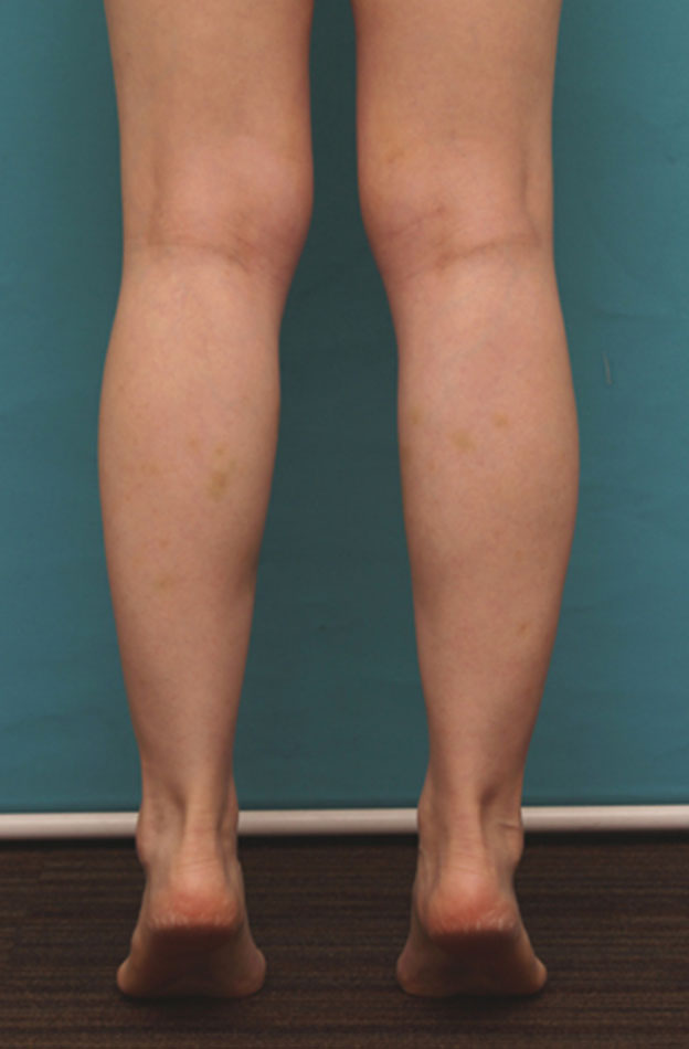 症例写真,ボツリヌストキシン注射（ふくらはぎ・足やせ・美脚）で腓腹筋とヒラメ筋を萎縮させ、細い美脚にした症例写真の術前術後画像,注射直後,mainpic_leg02f.jpg