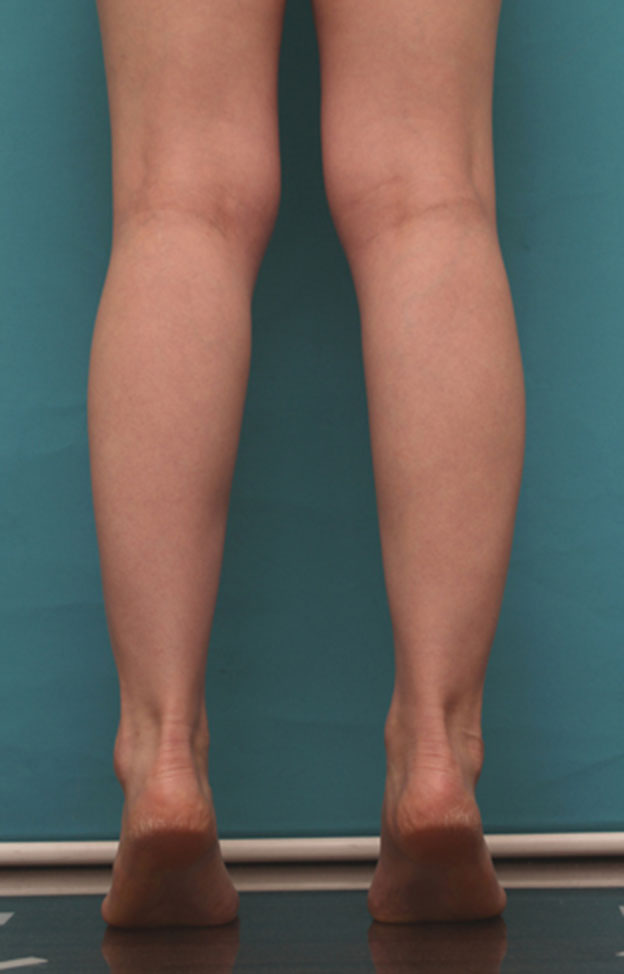 症例写真,ボツリヌストキシン注射（ふくらはぎ・足やせ・美脚）で腓腹筋とヒラメ筋を萎縮させ、細い美脚にした症例写真の術前術後画像,1ヶ月後,mainpic_leg02g.jpg