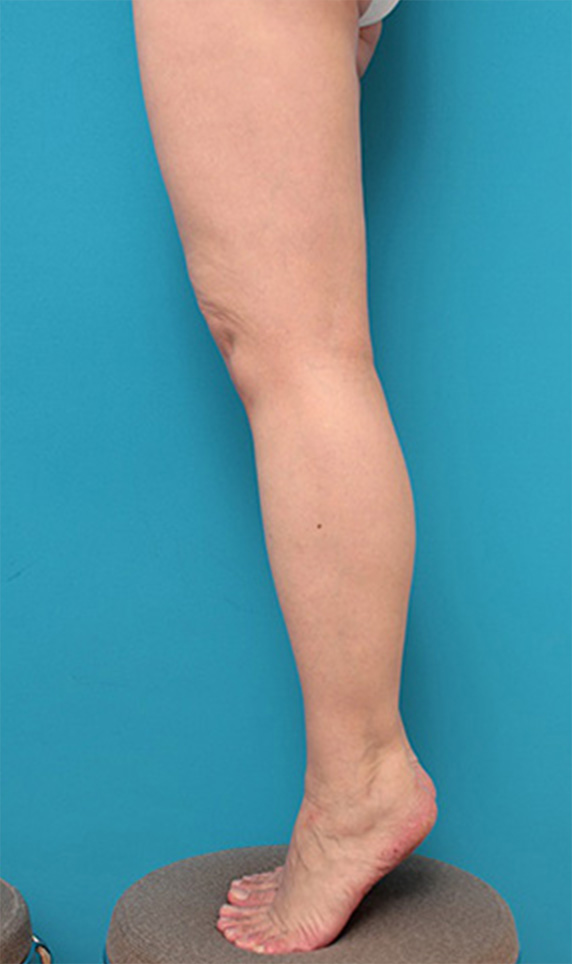症例写真,ボツリヌストキシン注射（ふくらはぎ・足やせ・美脚）,After（6ヶ月後）,ba_leg18_b.jpg