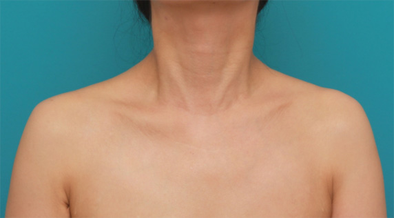 ボツリヌストキシン注射（美人肩）でゴツい肩をすっきりさせ、肩凝りも改善した症例写真の術前術後画像,After（1ヶ月後）,ba_shoulder_botox03_a01.jpg