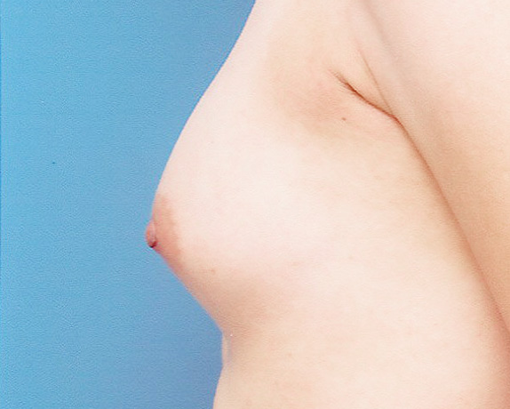 乳頭縮小の症例 薄い胸と大きな乳頭のアンバランスさが悩みの女性,After,ba_nyuto15_a01.jpg