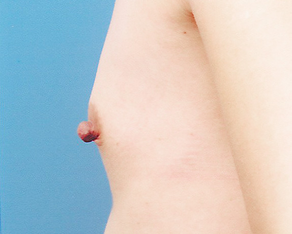 乳頭縮小の症例 薄い胸と大きな乳頭のアンバランスさが悩みの女性,Before,ba_nyuto15_b.jpg